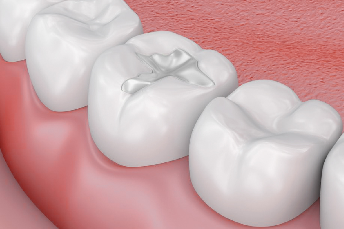 New Materials in Pediatric Dentistry 