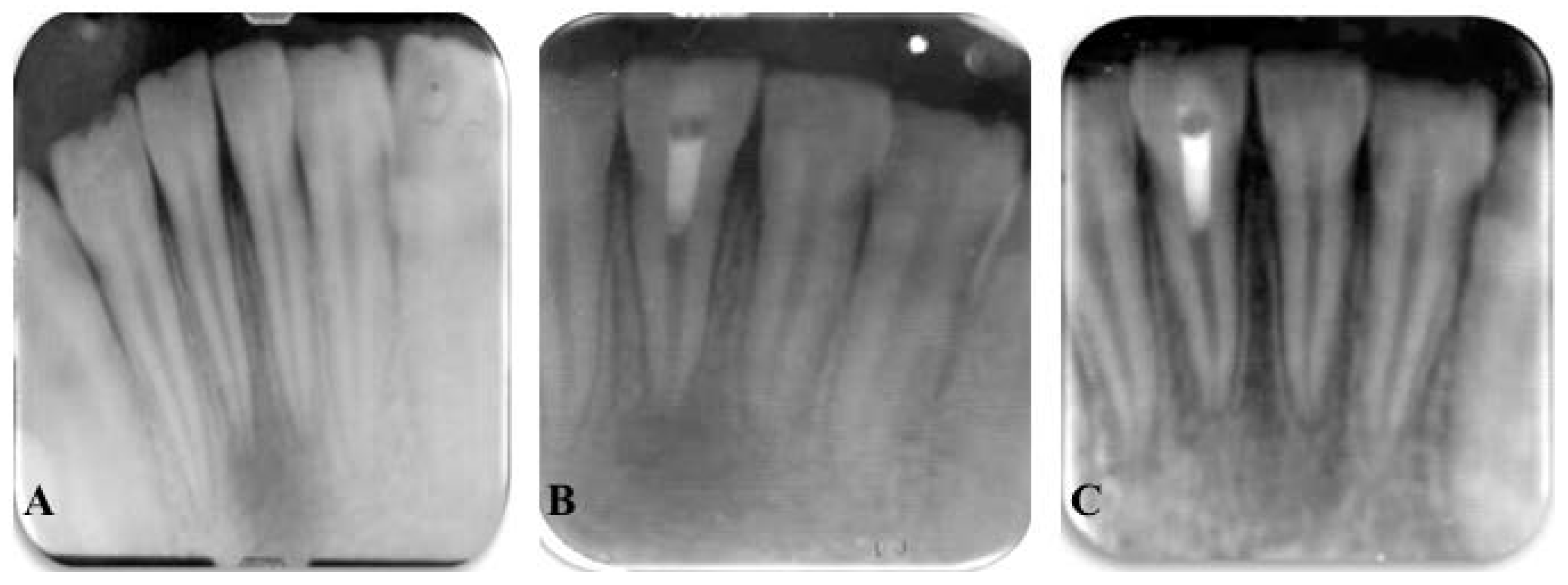 What is Regenerative Endodontics?