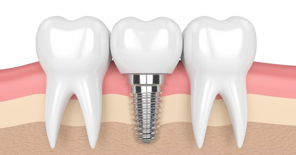 From Gaps to Grins: Your Guide to Dental Implants in Kerala