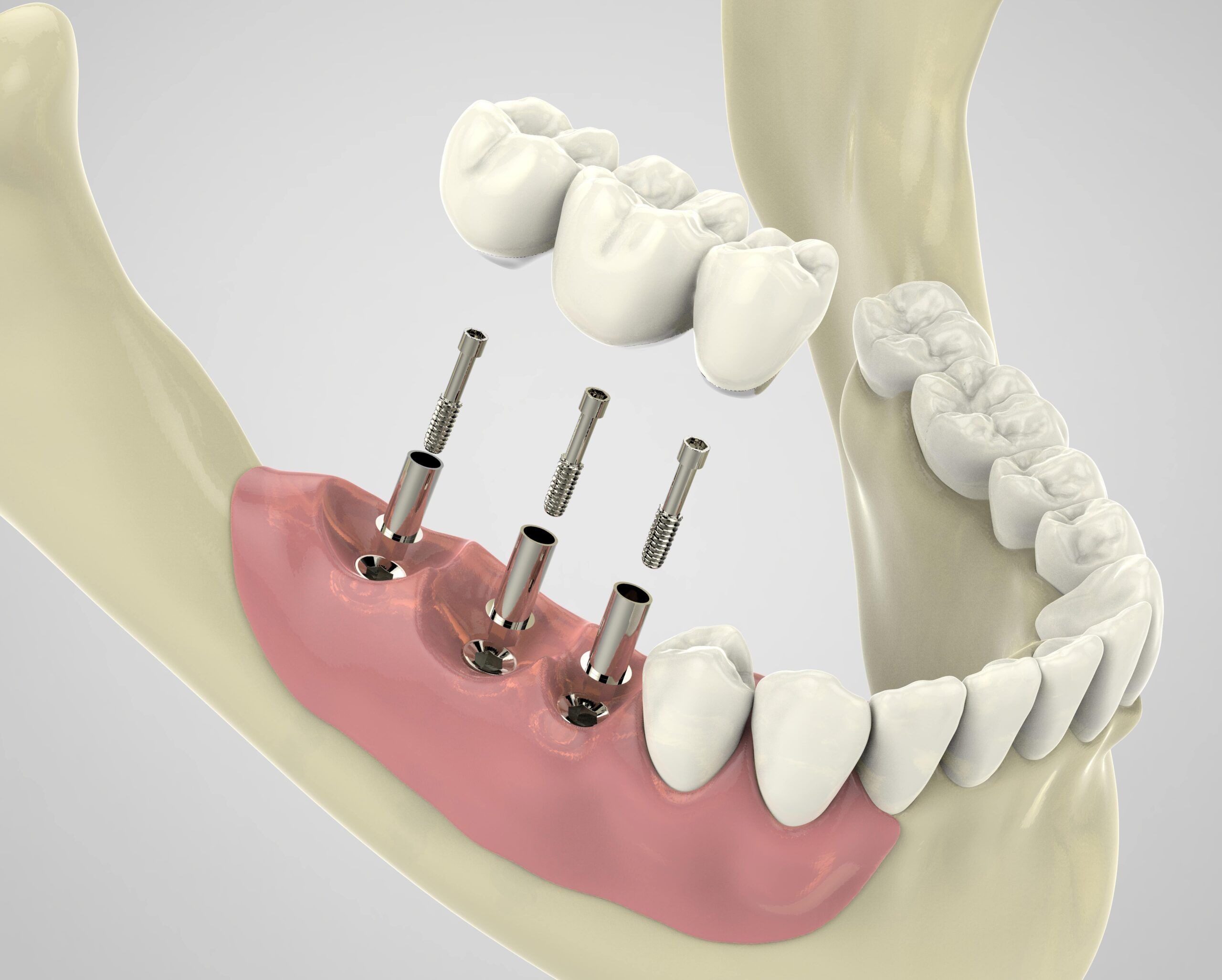 Why Choose Chitra MultiSpeciality Dental Clinic? 