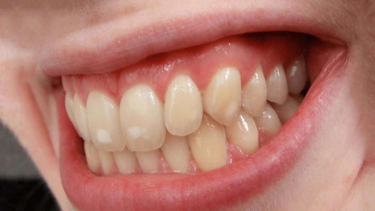 What is Dental Fluorosis?