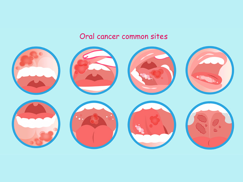 7 S’s of Oral Cancer