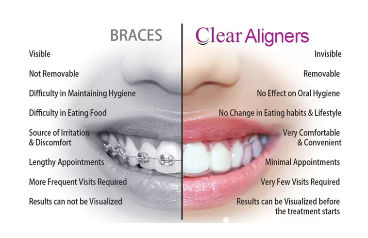 Clear Aligners Treatment