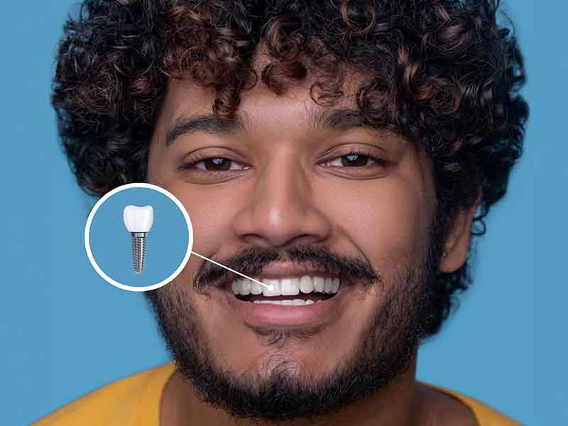 Dental Implants: The Permanent Solution for Missing Teeth