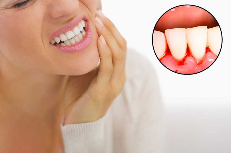 Bleeding Gums: Causes, Treatments, and Why Early Intervention Matters