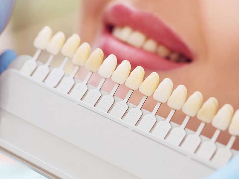 The Ultimate Tooth Whitening Guide: Tips from Chitra Dental Experts