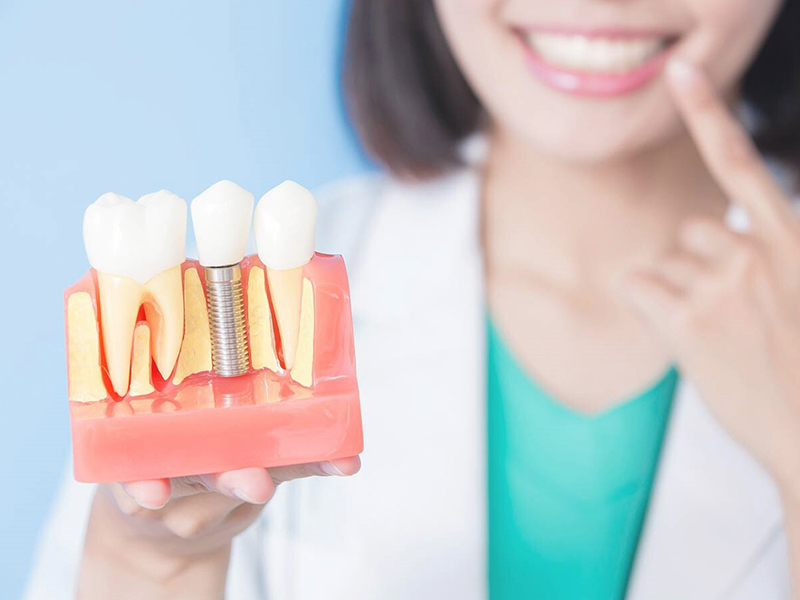 From Gaps to Grins: Your Guide to Dental Implants in Kerala