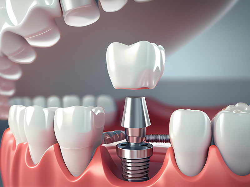 Immediate Implant Placement: Your Path to a Confident Smile at Chitra MultiSpeciality Dental Clinic