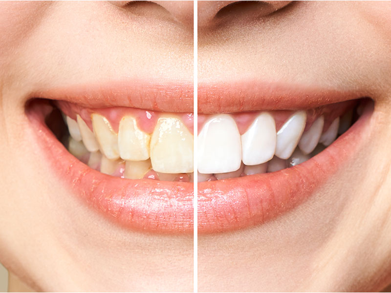 Say Goodbye to Stained Teeth