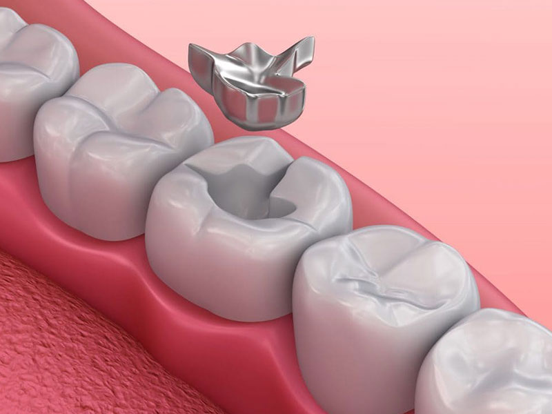 Silver Fillings: Are They Safe? Everything You Need to Know