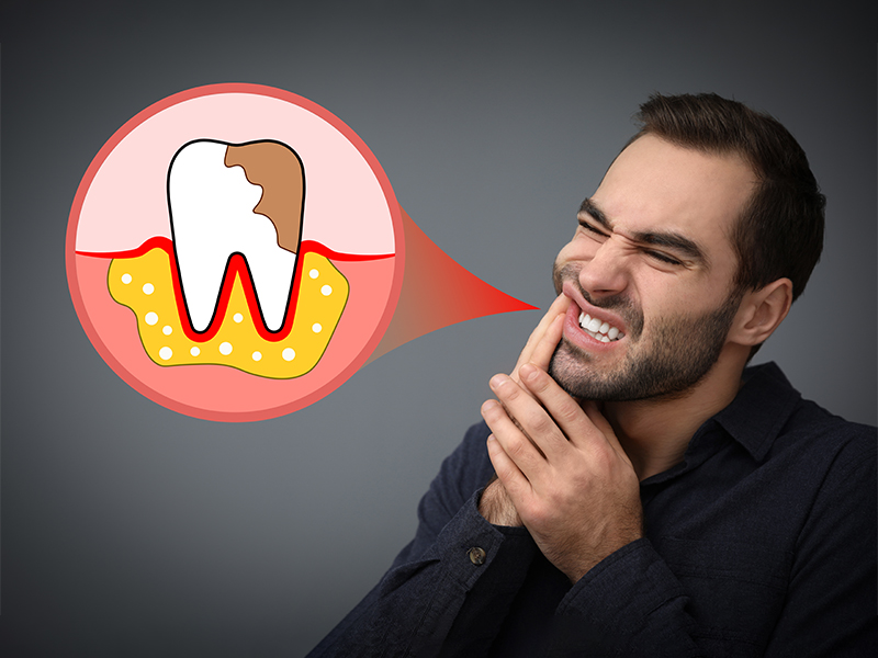 Gerd and Oral Health : What You Need to Know